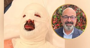 Choc sur les réseaux sociaux : un maire normand victime de brûlures au visage